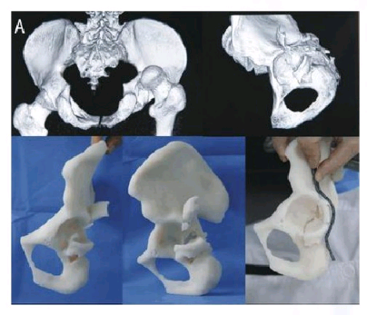 骨科3D打印機應(yīng)用